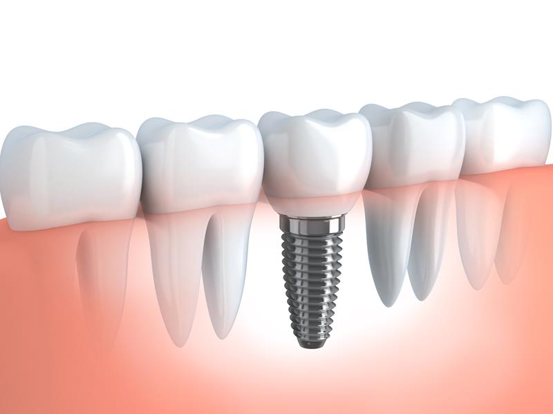 Dental Implants in Springfield, MO