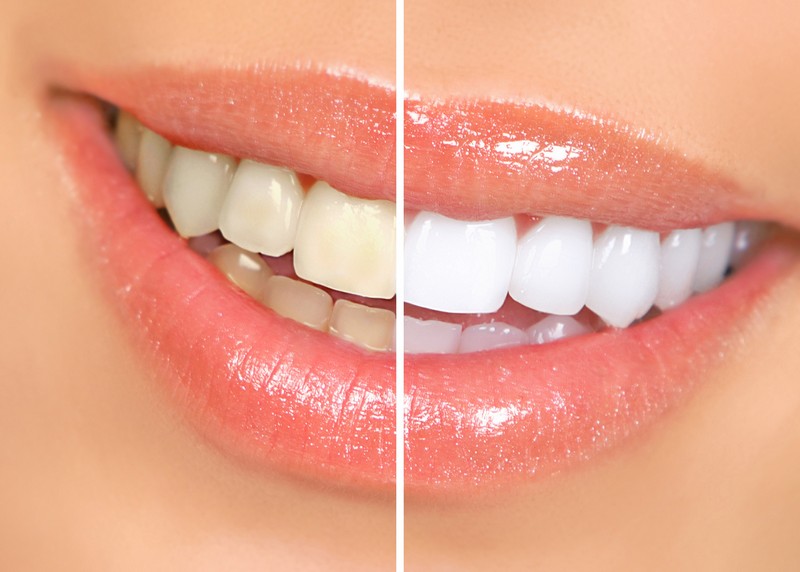 teeth whitening services in Springfield, MO